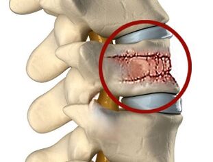 Ursachen für Rückenschmerzen können Erkrankungen der Wirbelsäule und der Bandscheiben sein. 