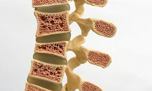 Osteoporose ist eine der Ursachen für Rückenschmerzen. 