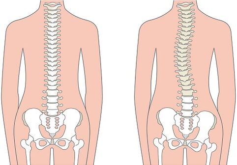 Schmerzen im unteren Rücken aufgrund einer Wirbelsäulendeformität wie Skoliose. 