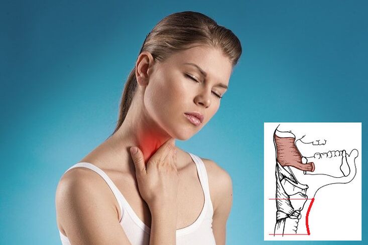 Halsschmerzen mit zervikaler Osteochondrose aufgrund von Nervenkompression. 