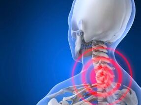 Osteochondrose der Halswirbelsäule. 