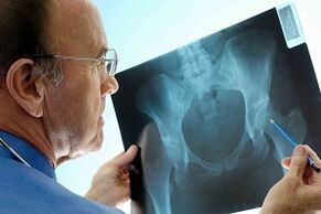 Hüftgelenk -Arthrose auf der X -Linie