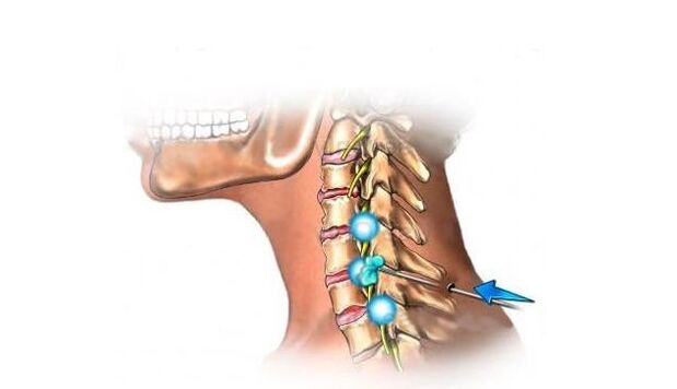Osteochondrose der Halswirbelsäule