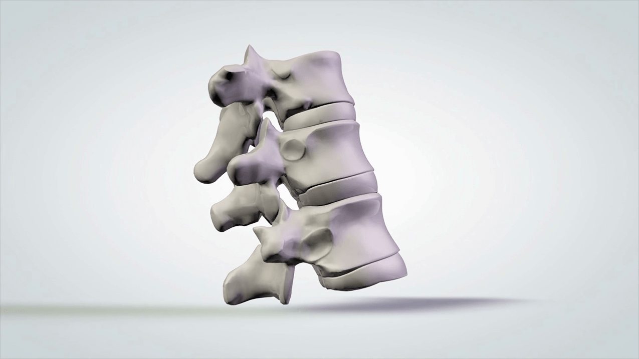 Schädigung der Wirbelsäule durch zervikale Osteochondrose.