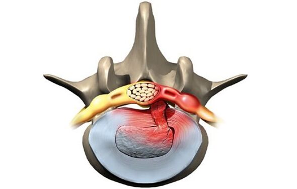 Von Osteochondrose betroffener Wirbel