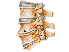 Anzeichen und Symptome einer Osteochondrose