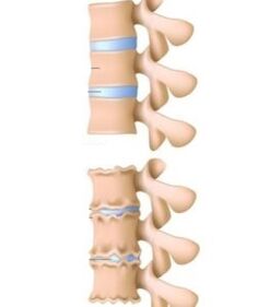 Ursachen der Osteochondrose